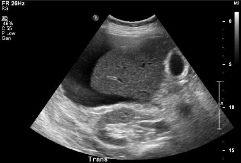 272 Journal of Diagnostic Medical Sonography 32(5) Figure 12. Transverse image of the liver/kidney/gallbladder interface displaying free fluid surrounding the right upper quadrant (RUQ) organs.