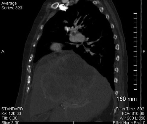 There was mild to moderate fluid in the abdomen and pelvis, which was previously seen on sonography. Focal infiltrates were visualized in the right lower lobe and left upper lobe of the liver.