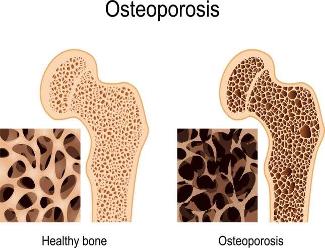 Osteoporosis Definition Osteoporosis causes bones to become weak and brittle so brittle that a fall or even mild stresses like bending over or coughing can cause a fracture.