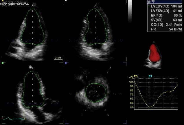 3-D Echocardiography Volumetric