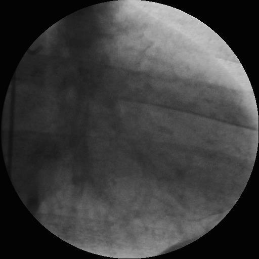 A High Risk Coronary Lesion Detected in a 46 year old Man with Multiple Risk Factors including Diabetes Ischaemic threshold : HR 100 220-age 220-46 57%