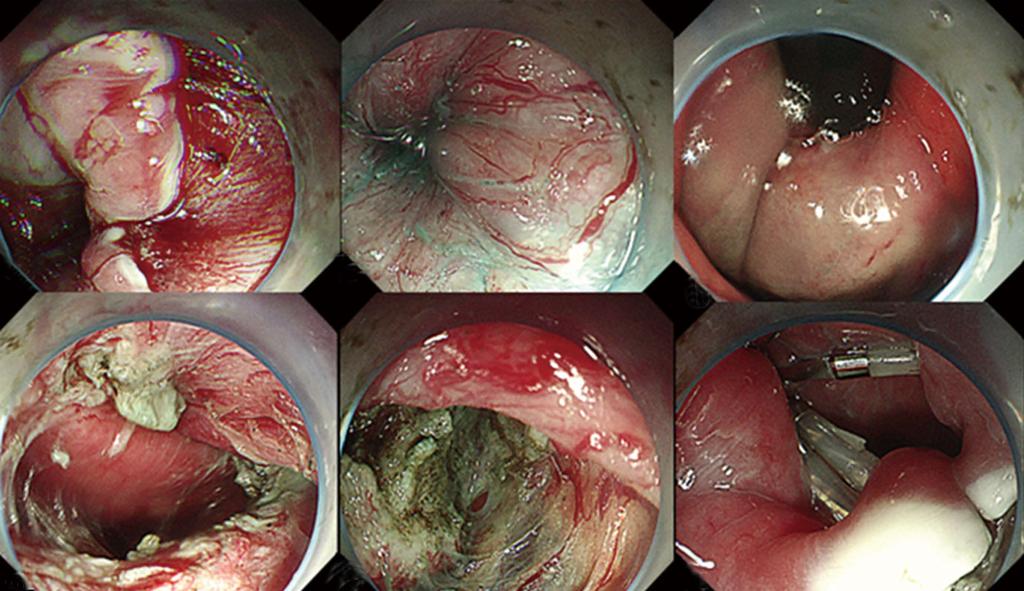 A B C D E F Figure 3 Peroral endoscopic myotomy procedure.