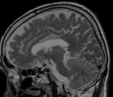 A B C D Figure1. Neuroimaging findings of the patient.