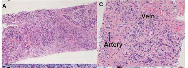 Autoimmune pancreatitis Histopathological features: Diffuse lymphoplasmacytic infiltration Stromal fibrosis Acinar atrophy