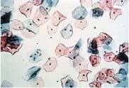 Cytology Primer ASC-US: atypical squamous cells of undetermined significance LSIL: low-grade squamous intraepithelial lesion HSIL: high-grade squamous intraepithelial lesion AGC: atypical glandular