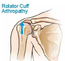 Reverse Total Shoulder Arthroplasty ROTATOR CUFF ARTHROPATHY: May occur following a chronic rotator cuff tear.