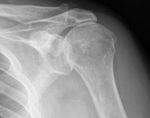 Introduction Reverse shoulder arthroplasty(rsa) was