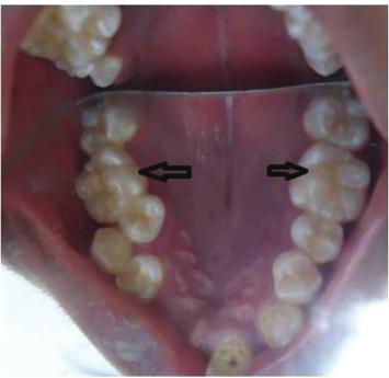 2 Case Reports in Dentistry Figure 1: Intraoral photograph showing transposition between 13 and 14 and multiple cusps in occlusal surface of the 1st maxillary molars (black arrows).