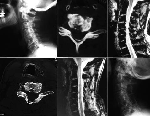 Fig. 2. Radiographic studies obtained in a 63-year-old man presenting with progessive myelopathy and right-hand numbness.