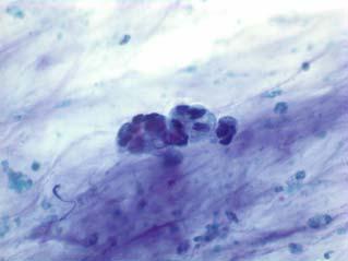 Atypical Epithelial Cells Cytological