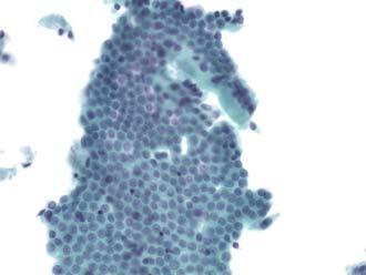 Nondiagnostic Definition: A non-diagnostic cytology specimen is one that provides no diagnostic or useful information about the lesion sampled.
