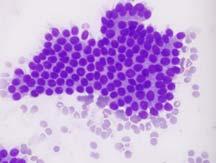 Lymphoepithelial Cyst