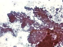 Benign Pancreatic Tissue