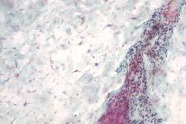 Lymphoepithelial Cyst Anucleate squames