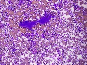 Spenule/accessory spleen Lymphoid tissue Histiocytes Blood vessels Fibrin aggregates with embedded lymphocytes and plasma cells Example Report: Negative vs.