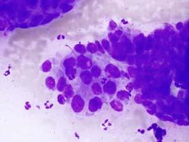 Cytologic Criteria Poorly Differentiated Pancreatic Ductal Adenocarcinoma Extreme