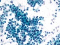 Cytologic Criteria Acinar Cell Carcinoma Usually hypercellular, mostly small to mid-sized