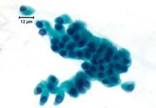 Cytological Criteria of High-Grade Epithelial Atypia in the Cyst Fluid of Pancreatic