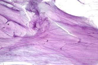 Example Report Evaluation limited by scant cellularity Neoplastic: Other Thick, colloid-like