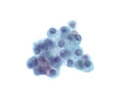 Neoplastic: Benign Definition: This interpretation category connotes the presence of a cytological specimen sufficiently cellular