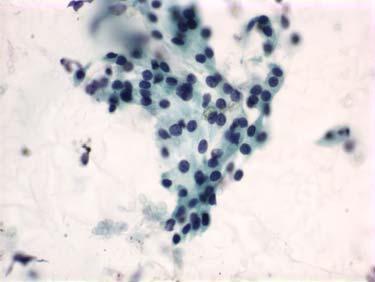 Example Report Evaluation limited by scant cellularity Neoplastic: Benign Scant nonmucinous cuboidal epithelium in a nonmucinous cyst fluid with low CEA (4ng/ml) and amylase (12 U/L) consistent with