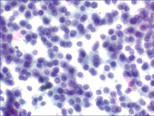 Well-differentiated PanNET highly cellular aspirate with solid-cellular smear pattern predominantly isolated cells, bare nuclei pseudorosettes and small clusters uniform, round/oval nuclei eccentric