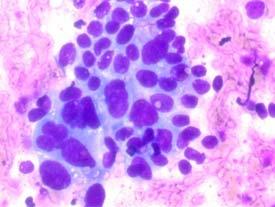 Positive/Malignant Definition: unequivocal display of malignant cytologic characteristics Adenocarcinoma of the pancreatobiliary ducts, and variants Acinar cell