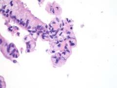 Pancreatic Ductal Carcinoma and carcinomas of biliary and main pancreatic duct (85-90% of all carcinomas) Cytological Criteria Well-differentiated PDAC Variable cellularity with