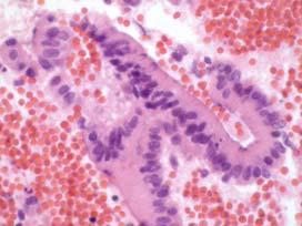 Note: An immunohistochemical stain for SMAD4 shows loss of staining in the
