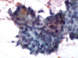 Cytological Criteria Moderately Differentiated Pancreatic Ductal