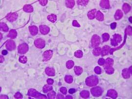 for Lymphoma Cellular smears of non-cohesive cells Predominance of large immature lymphoid cells