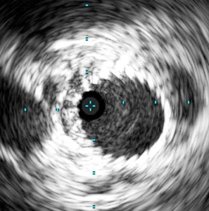 IVUS IVUS Flow resistance decreases with the more circular shape of the vessel and stent Aspect Ratio