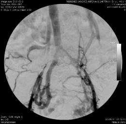 inferior vena cava disease-free or should it also be treated?
