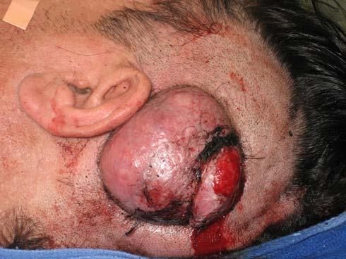 Head and Neck Pathol (2009) 3:42 46 43 occasionally bleed. He had no history of significant sun exposure, alcohol or tobacco use.