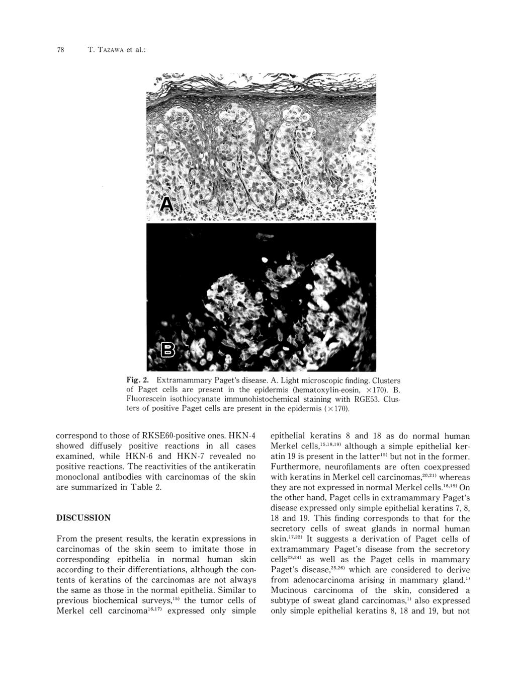 78 T. TAZAWA et a1.: Fig. 2. Extramammary Paget's disease. A. Light microscopic finding. Clusters of Paget cells are present in the epidermis (hematoxylin-eosin, x 170). B.