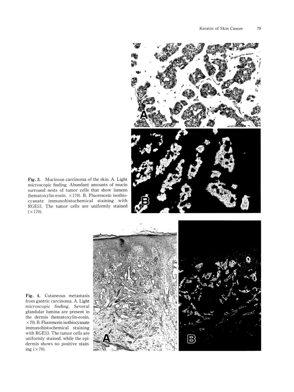 Keratin of Skin Cancer 79 Fig. 3. Mucinous carcinoma of the skin. A. Light microscopic finding. Abundant amounts of mucin surround nests of tumor cells that show lumens (hematoxylin-eosin, x 170). B.