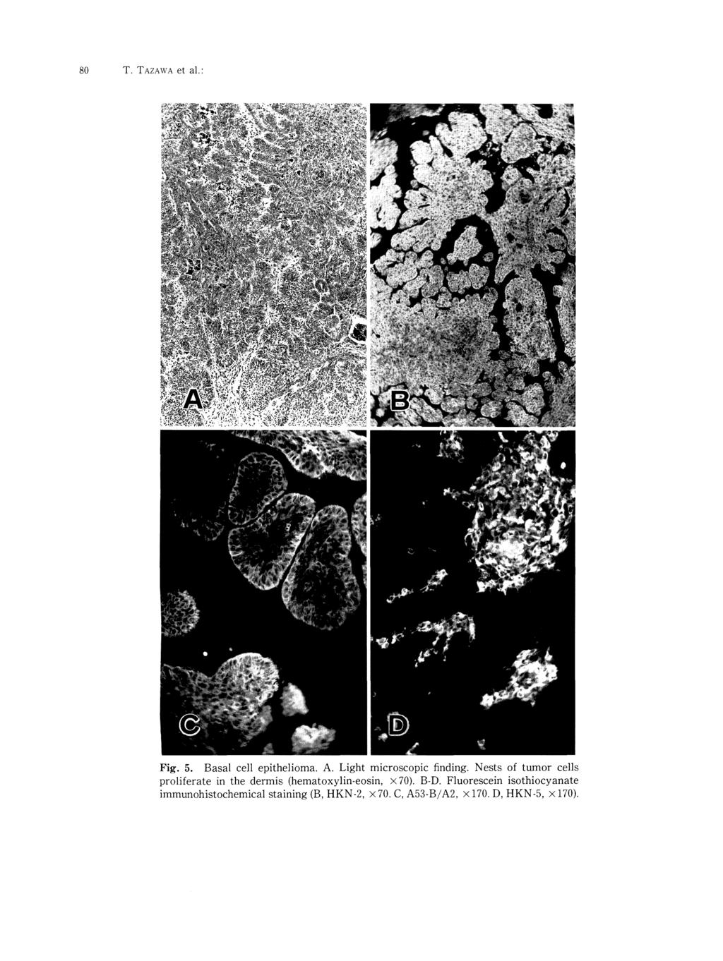 80 T. T AZAWA et al.: Fig. 5. Basal cell epithelioma. A. Light microscopic finding.