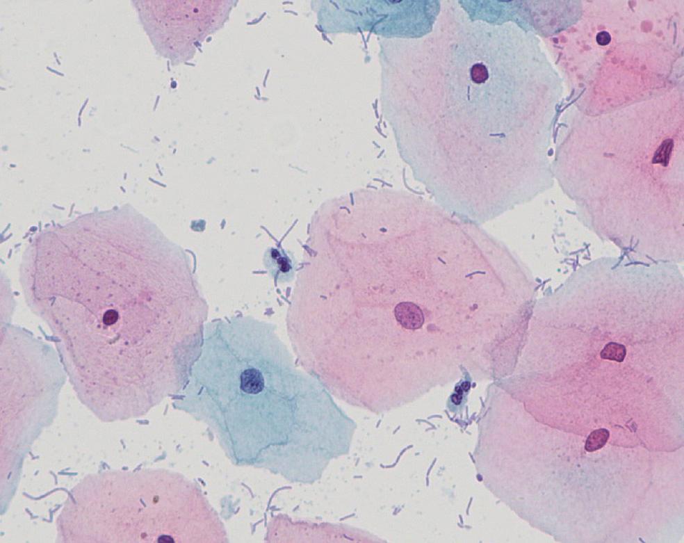 Cervicovaginal Cytology: Normal and Abnormal Cells and Adequacy of Specimens 3 Christine Bergeron, MD, PhD Introduction Carcinoma of the cervix is a slow growing cancer, which is preceded by