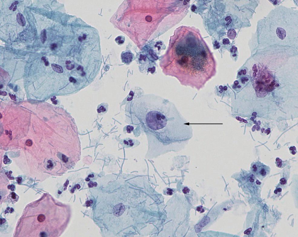Cervicovaginal Cytology: Normal and Abnormal Cells and Adequacy of Specimens u 17 Table 1. The 2001 Bethesda System.
