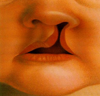 Structural Defects (Cleft Lip & Cleft palate) Clefts of the lip (CL) and palate (CP) are facial malformations that occur during embryonic development and are the most common Page 54 of