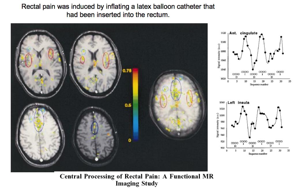 Visceral Pain Note: although we can track somatotopic map does not mean its involved in perception of stimulus localization.