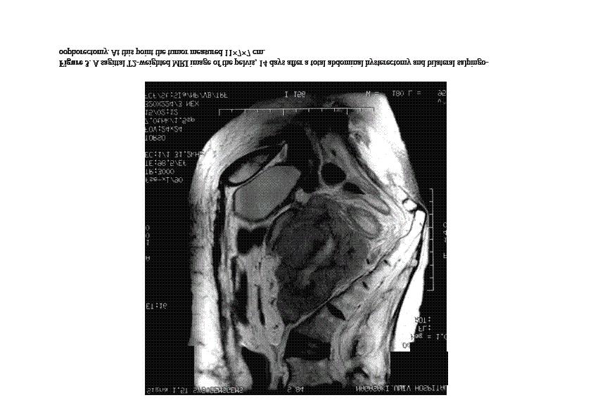 Figure 3. A sagittal T2-weighted MRI image of the pelvis, 14 days after a total abdominal hysterectomy and bilateral salpingooophorectomy. At this point the tumor measured 11 7 7 cm.