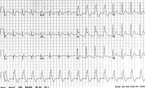 65 yo Asian man who presents with recurrent syncope. Echo was normal.