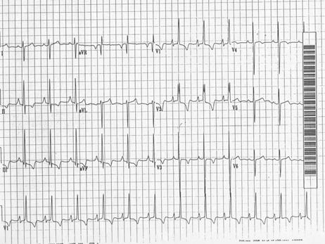 36 yo woman presenting to the ED with acute dyspnea.