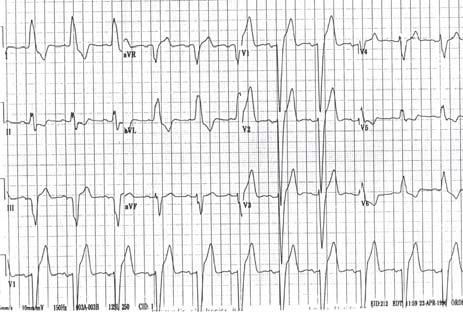 84 yo woman with pneumonia Which of the following answers about LBBB is not true? A.