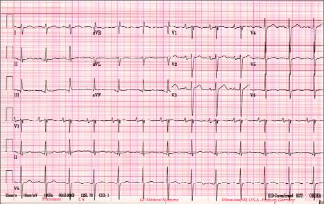 In most patients with LBBB, septal wall motion abnormalities can exist without coronary artery disease C.