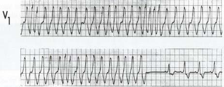 Wide QRS-complex tachycardia (QRS > 120 ms) Regular or irregular? Regular Is QRS identical to that during SR?