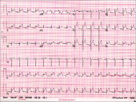 STEMI - ACS If the patient s history and clinical presentation is consistent with ACS IT DOESN T MATTER WHAT THE ECG LOOKS LIKE!