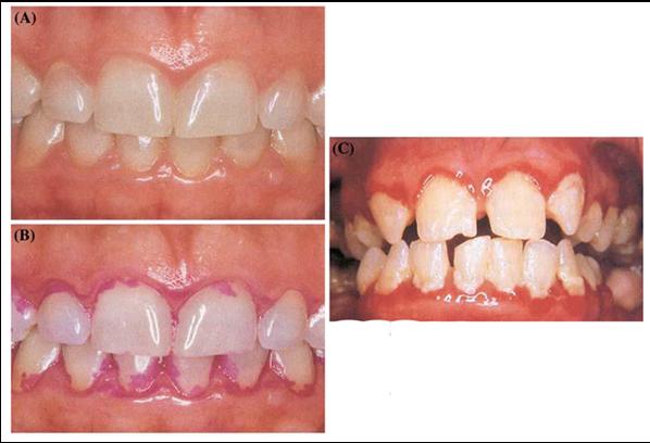 The Oral Microbiota Distribution Accumulation at: Gingival margins (gingivitis / periodontal disease) Tooth fissures (dental caries) Tongue and other