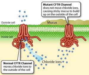 Cystic fibrosis Disease that affects the respiratory and digestive systems Mutation of gene encoding chloride channel essential for production of sweat, mucus, and